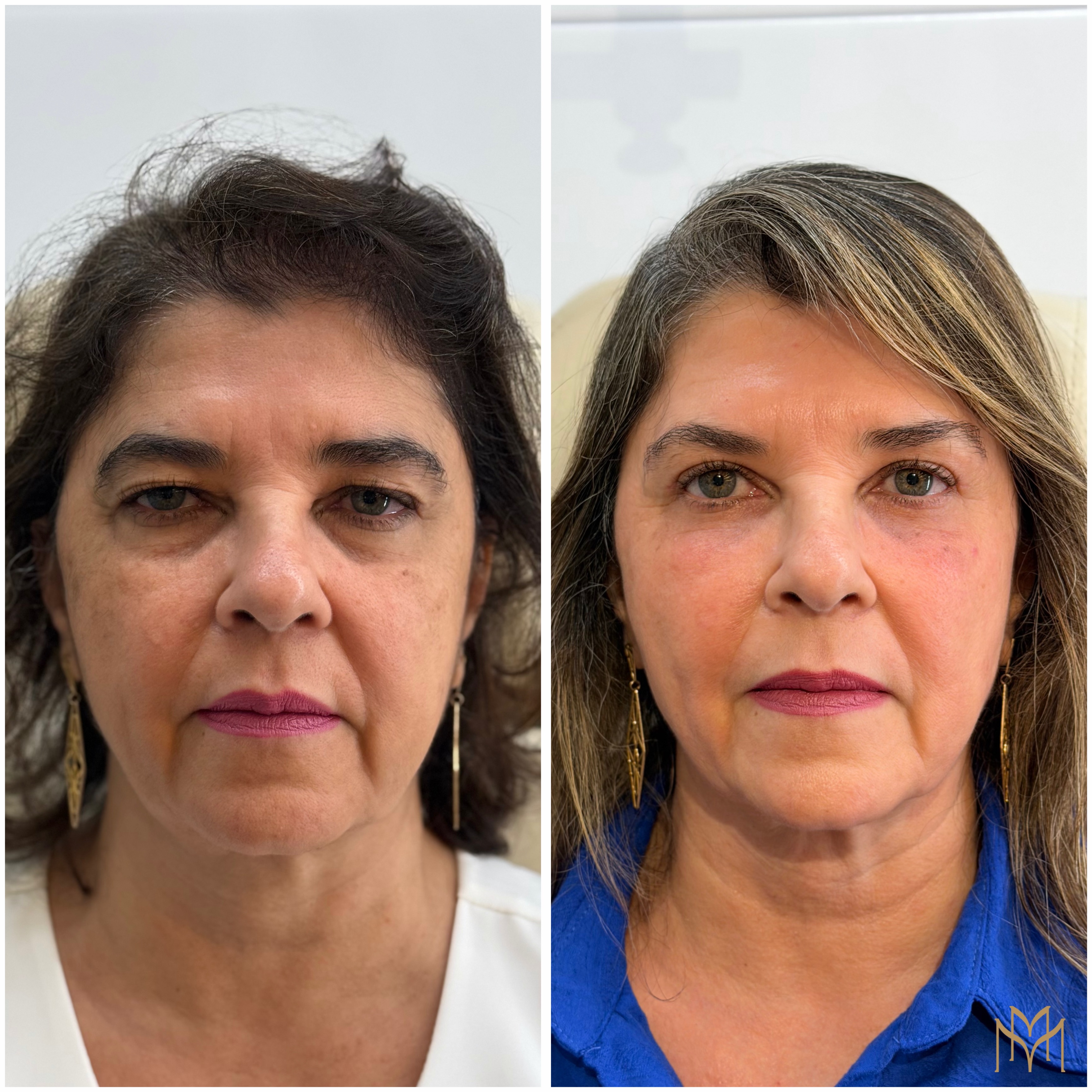 Rejuvenescimento Elegante e Natural