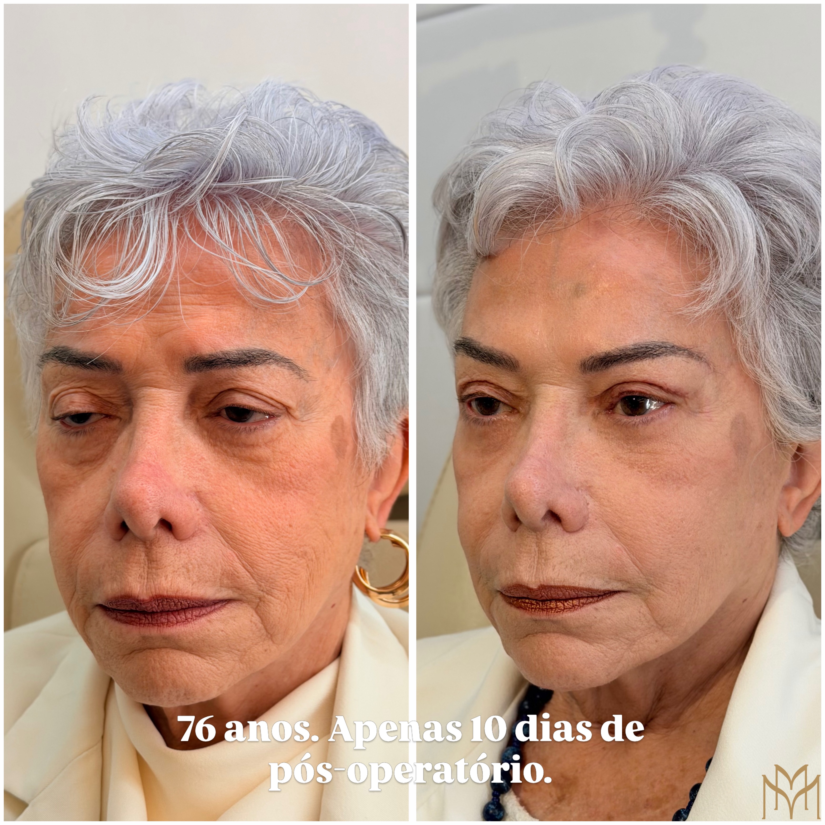 Transformação aos 76 Anos: Colega Médica